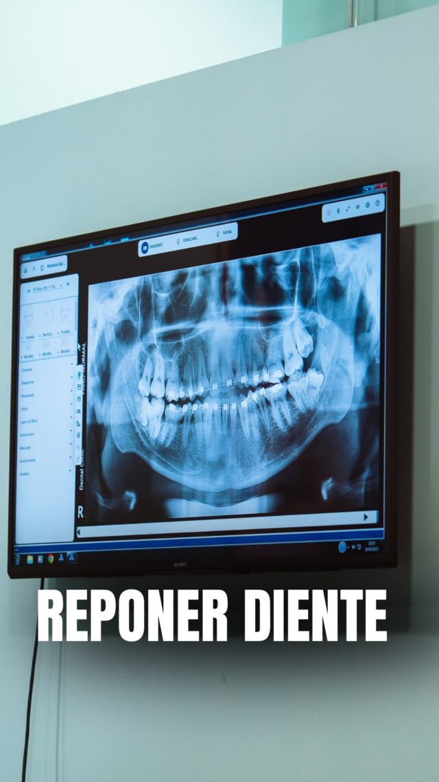 ¿Has perdido un diente y piensas ‘total no se ve’? Gran error. 😬 

No reponerlo puede mover el resto de tus dientes, alterar tu mordida y hacer que pierdas hueso con el tiempo. ¡Tu sonrisa (y tu salud) te lo agradecerán! 🦷✨

📍C/Colón de Larreategui 17, Bilbao
📍C/Amezti 7 Bajo, Algorta