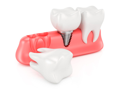 implantes-dentales-en-bilbao implantes dentales en bilbao