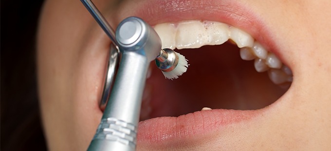 Limpiezas dentales profesionales cepillos giratorios