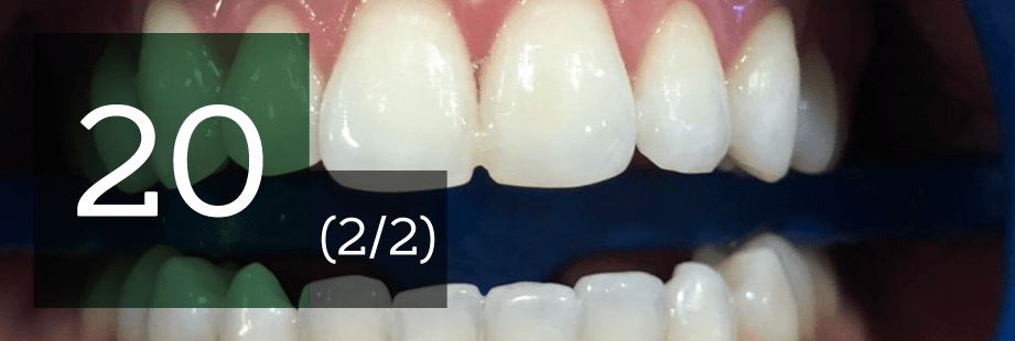 20 preguntas sobre el blanqueamiento de dientes