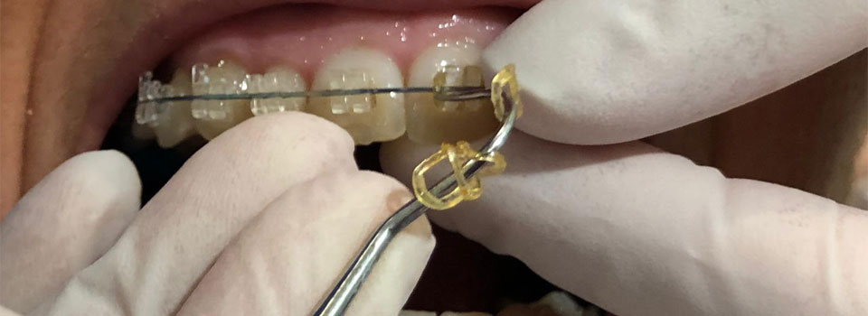 brackets de zafiro